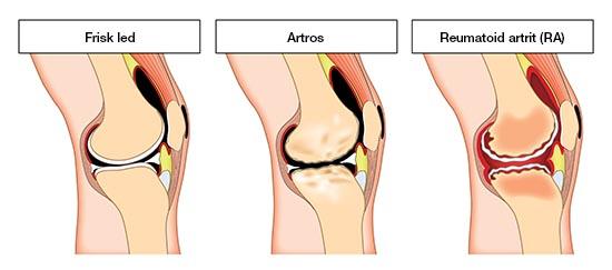 artros knä idrottsskadeexperten